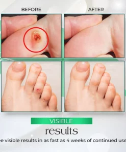 PodiaCorn™ Foot Corn Removal Cream