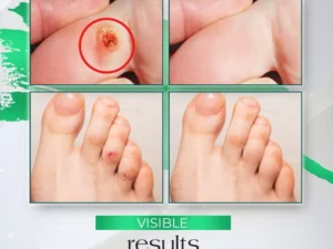 PodiaCorn™ Foot Corn Removal Cream