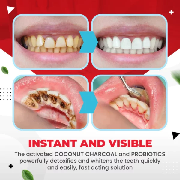 ProbiSmile™अल्ट्रा-व्हाइटनिंग प्रोबायोटिक्स पोलिश टूथपेस्ट