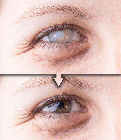 RestoreVision™ Ultra Eye Therapy 润滑眼部喷雾