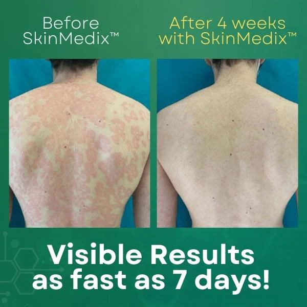 S.Medix™ Psoriasis کریم