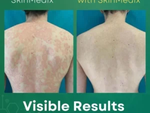 S.Medix™ Psoriasis Cream