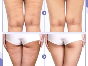 SKINNIER Anticellulite & Tightening Thigh Patch