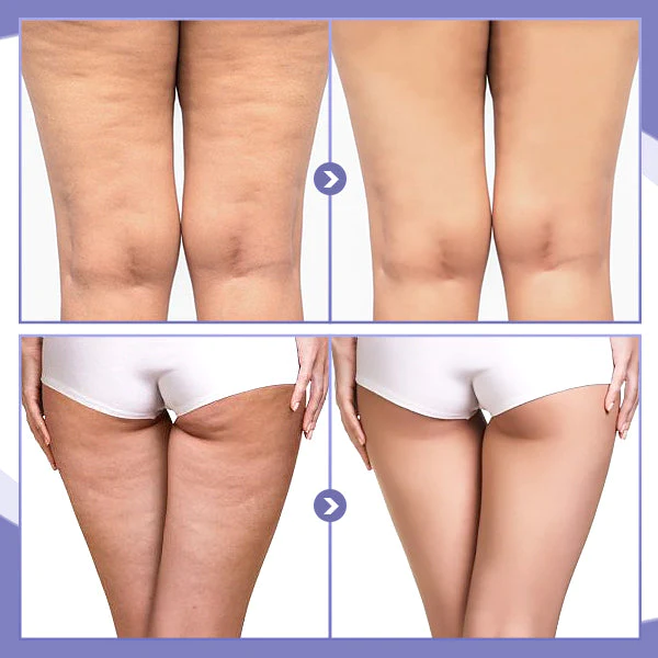 SKINNIER Anticellulite & Tightening Læri Plástur