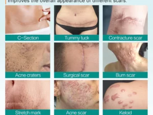 ScarRemove™ Advanced Scar Spray