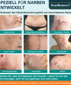 Alternative view of ScarRemove™ Fortgeschrittenes Narbenspray für alle Arten von Narben
