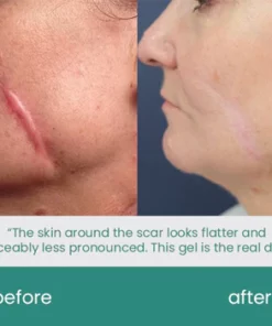 ScarXpert™ Advanced Scar Removal Gel