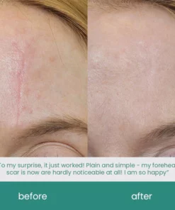 ScarXpert™ Advanced Scar Removal Gel