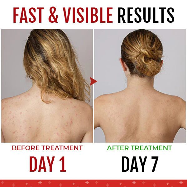 SkinCare™ Spray para o tratamento do acne nas costas