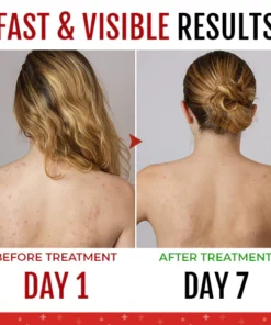 SkinCare™ Back Acne Treatment Spray