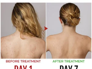 SkinCare™ Back Acne Treatment Spray