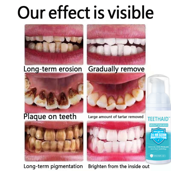 TEETHAID™ MOUTHWASH thiab CALCULUS REMOVAL