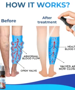 Veinhealing Varicose Veins Treatment Spray