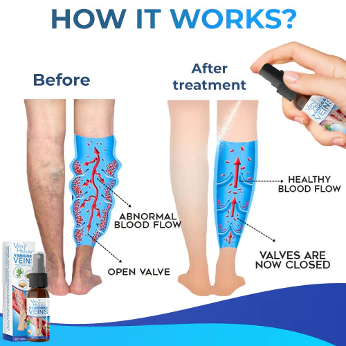 Veinhealing Varicose Veins ٹریٹمنٹ سپرے