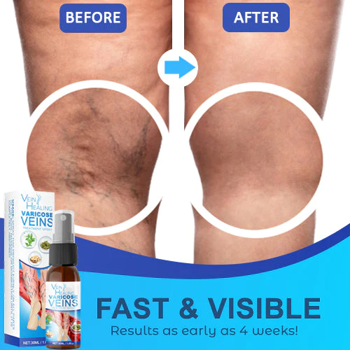 Veinhealing Varicose Veins ស្ព្រាយបាញ់ព្យាបាល