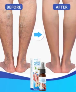 Veinhealing Varicose Veins Treatment Spray
