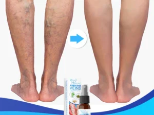 Veinhealing Varicose Veins Treatment Spray