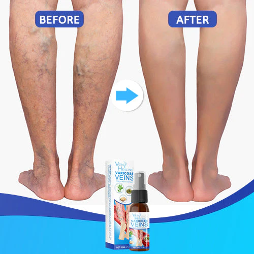 Veinhealing Varicose Veins उपचार स्प्रे