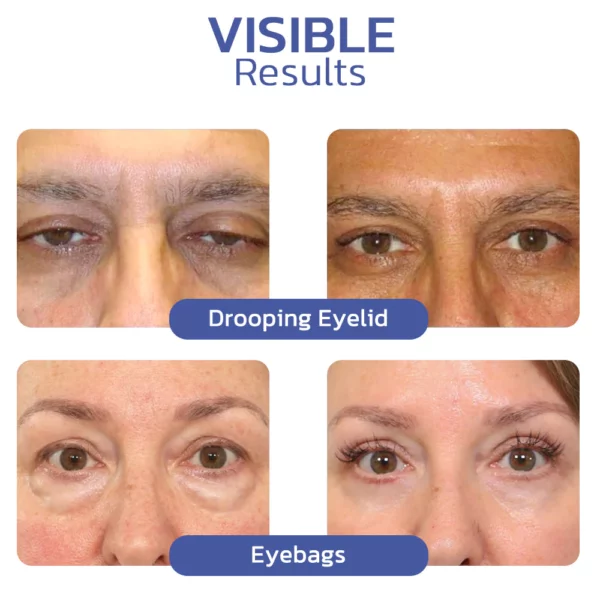 flysmus™ BIGEYES Gbígbé Eyelid asọye ipara