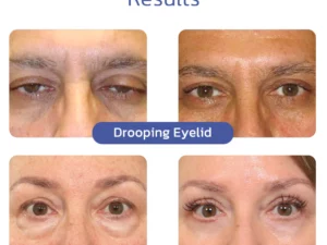 flysmus™ BIGEYES Lifting Eyelid Defining Cream