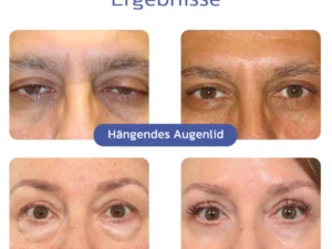 flysmus™ BIGEYES Straffende Creme zur Definition der Augenlider
