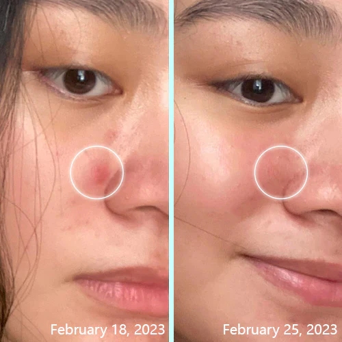 ACRēN™ Hydrocolloid Face Patches - Image 6