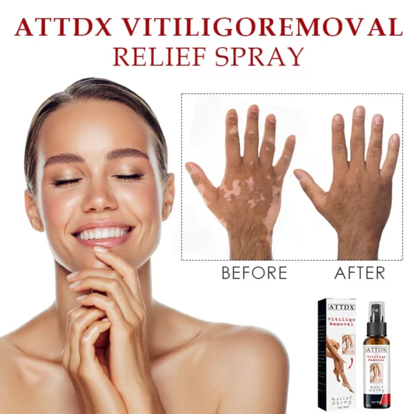 Spray para aliviar el vitiligo ATTDX