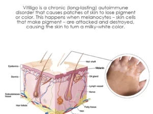ATTDX VitiligoRemoval Relief Spray