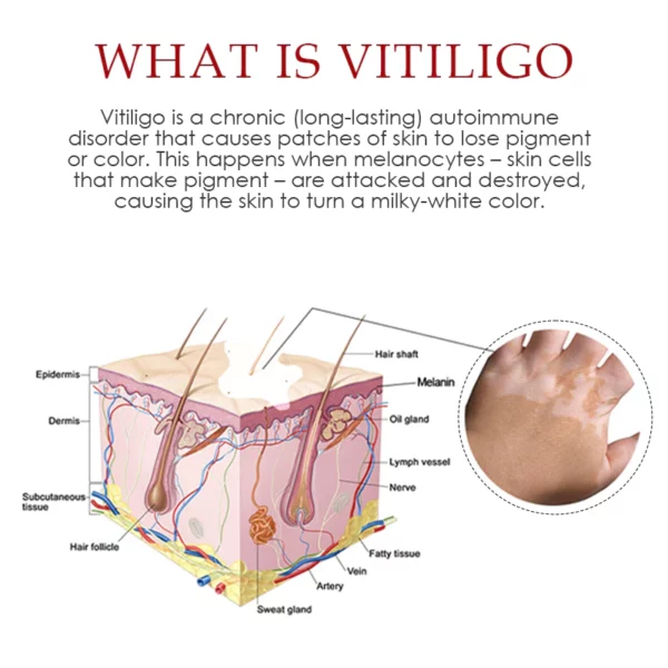 Spray para aliviar el vitiligo ATTDX