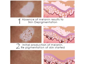 ATTDX VitiligoRemoval Relief Spray