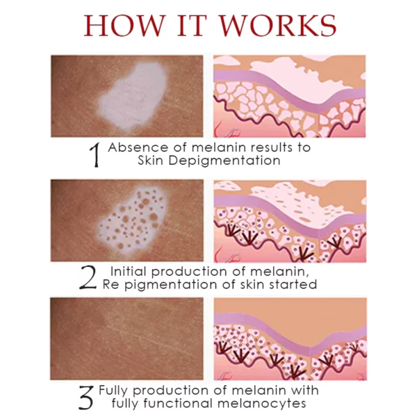 Spray para aliviar el vitiligo ATTDX