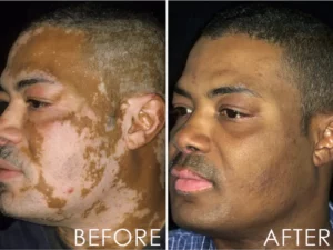 ATTDX VitiligoRemoval Relief Spray