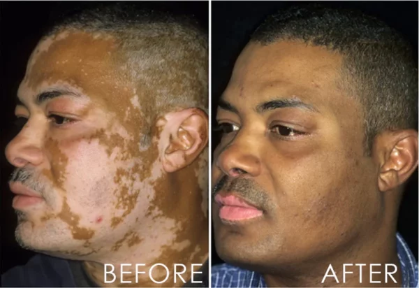 Spray para aliviar el vitiligo ATTDX