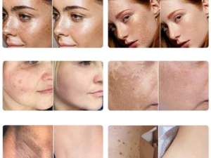 Blemish Treatment Serum