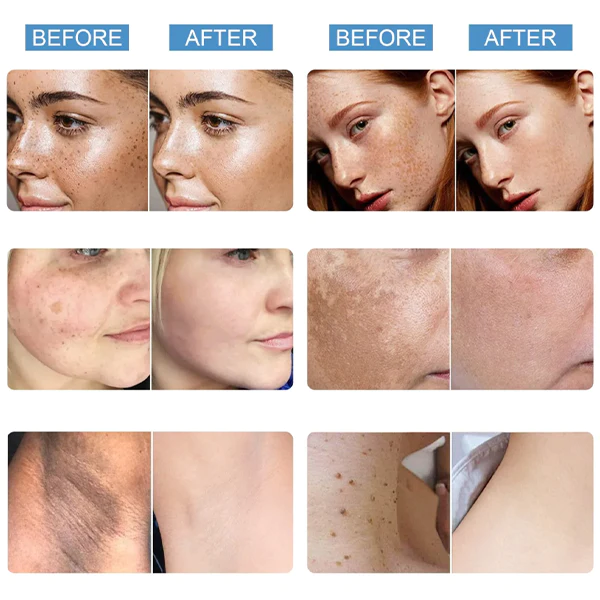 Serum de tratamento de manchas
