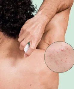 Alternative view of EELHOE™ Back Acne Treatment Spray