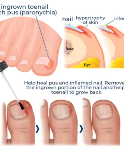 Fivfivgo™ Gel zur Behandlung von Nagelpilz