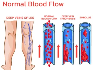 GFOUK™ VeinLess Immediate Relief Herbal Patch
