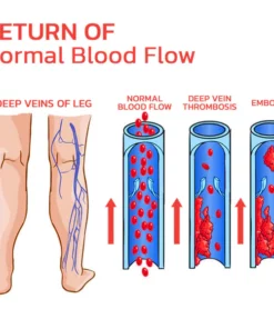 GFOUK™ VeinLess Kräuterpflaster zur sofortigen Linderung