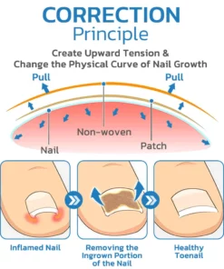 German ToenailHeal Paronychia Relief Patchs