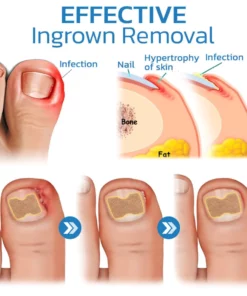 German ToenailHeal Paronychia Relief Patchs