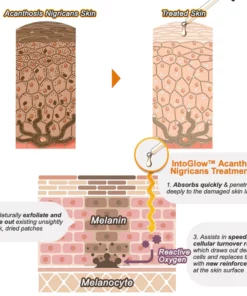 Alternative view of IntoGlow™ Acanthosis Nigricans Treatment Oil