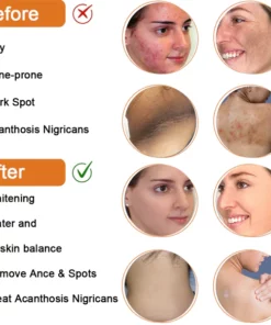 MX™ Cleansing Lotion for Acne & Spots & Acanthosis Nigricans