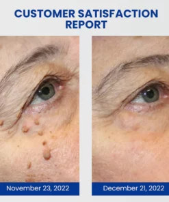 NeigeusesTM WartsOff Instant Blemish Removal Cream