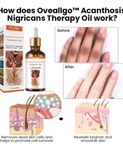 Alternative view of Oveallgo™ Acanthosis Nigricans Therapy Oil