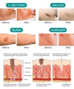 ProRegen™ Medical Scar Removal Spray