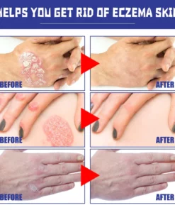 Psoriasis Relief Spray