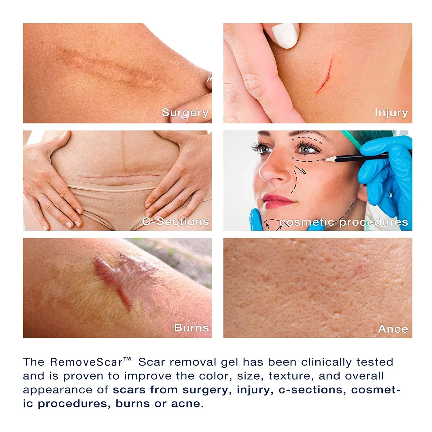 RemoveScar™ Advanced Scar Remove gel