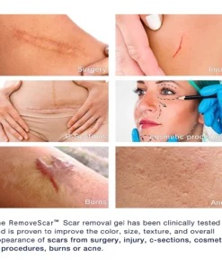 RemoveScar™ Advanced Scar Remove gel