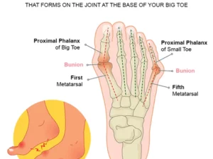 StrongJoints Anti Bunion Patches
